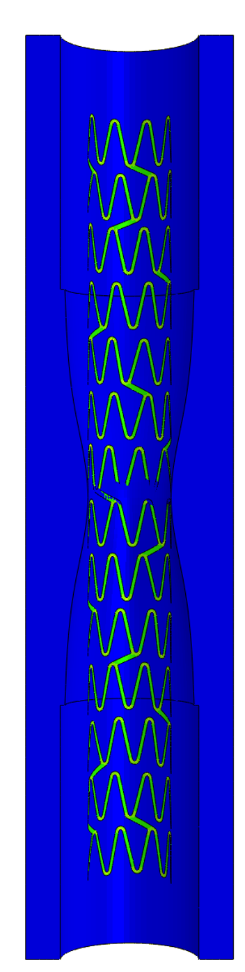 Angioplasty stent